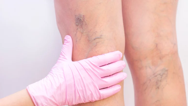 cosmetic clinic perth skincare sclerotherapy spider veins