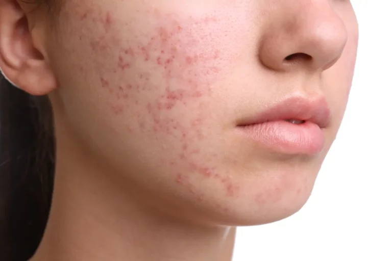girl with acne and acne scarring treatments perth