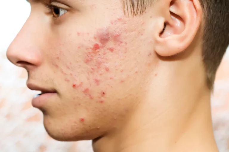 man with acne and acne scarring treatments perth
