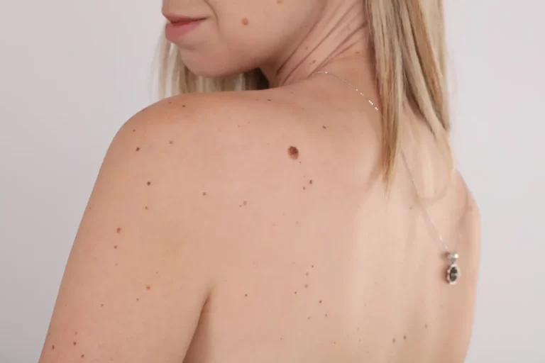 Moles and skin tag removal perth