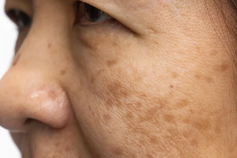 older woman with age spots on her face