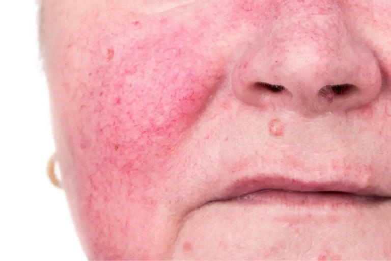 Rosacea on the cheaps and nose