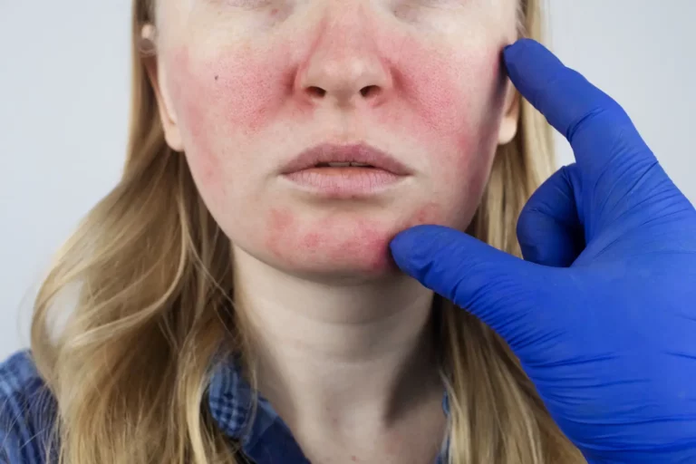 lady dealing with rosacea and redness (1500 x 1000 pixels)