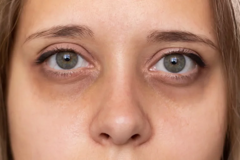 dark under eye circles treatment perth